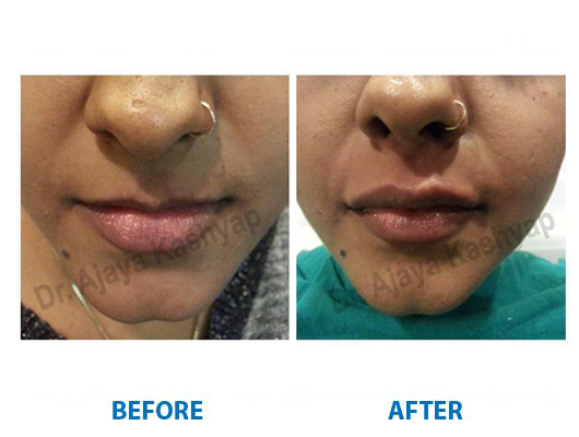 lip augmentation